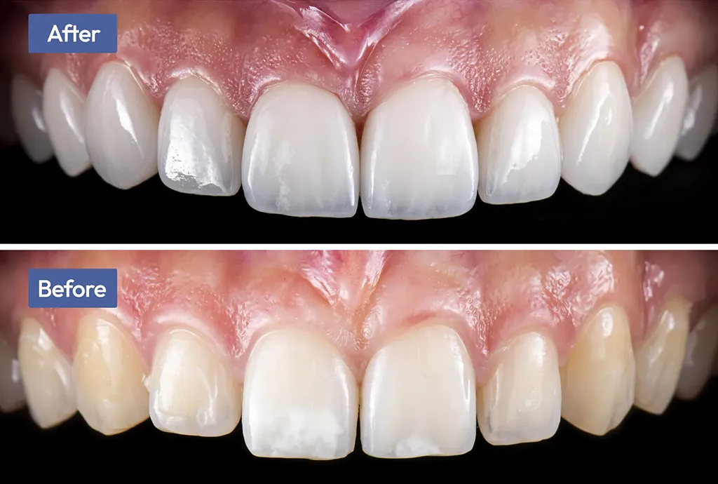 Before & After Patient Smile Makeover